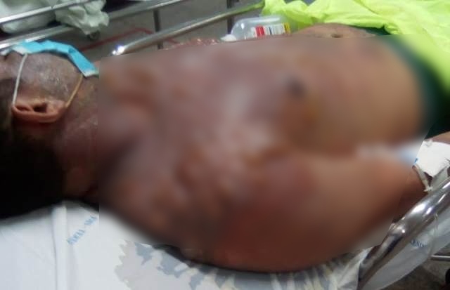 Jovem sofre queimaduras de 3º grau após receber banho de água quente da mãe da namorada